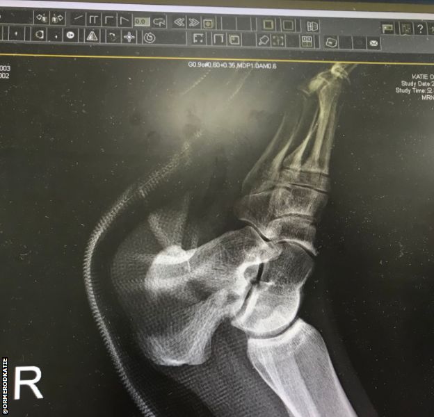 X-ray of Katie Ormerod's heel