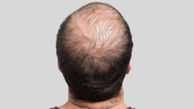 Hombre que sufre alopecia