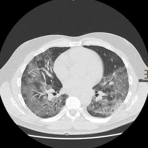 Exame de imagem dos pulmões