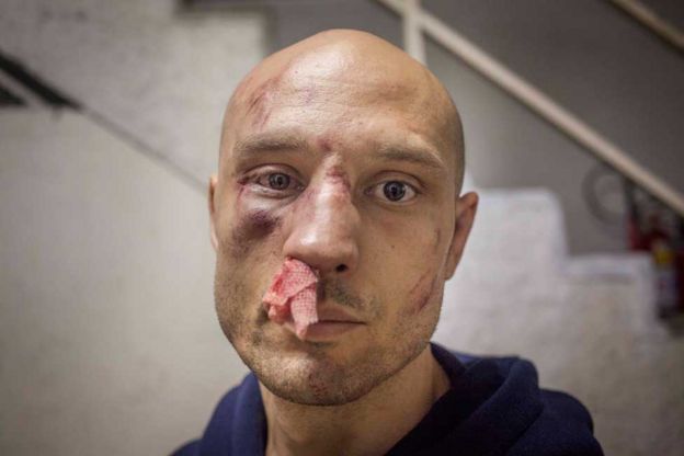 Lutador de MMA com ferimentos