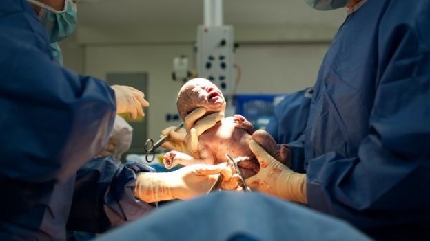 Bebé naciendo a través de una cesárea