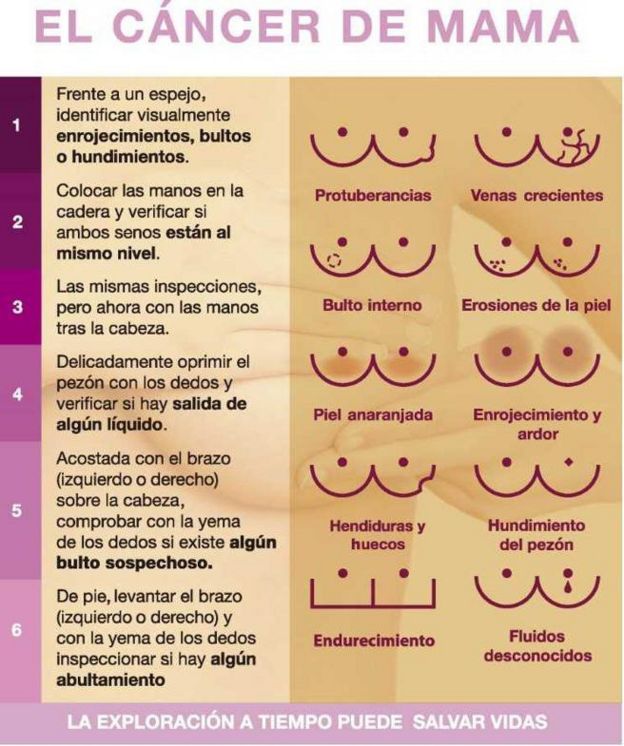 Cartel informativo sobre síntomas del cáncer de mama