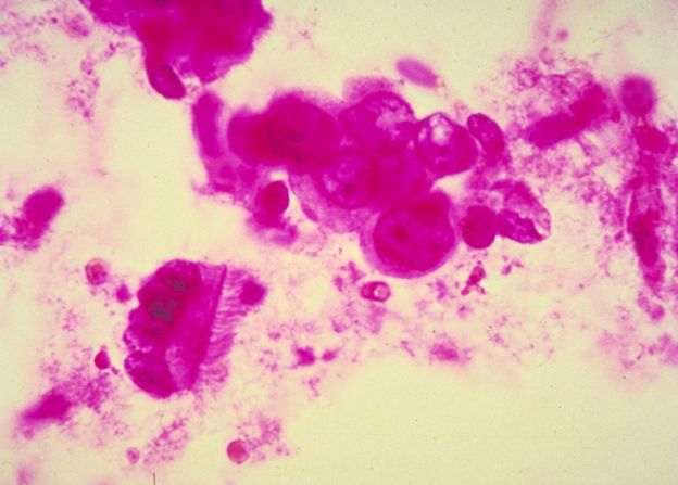 Células del cáncer de mama