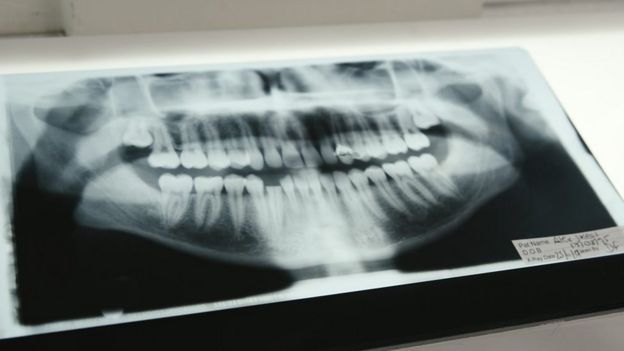 X光片顯示阿歷克斯被打傷的牙齒