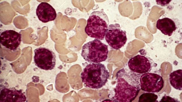 CLL is a cancer where excess white blood cells called lymphocytes form - these are mature lymphocytes (purple) with red blood cells (pale orange)