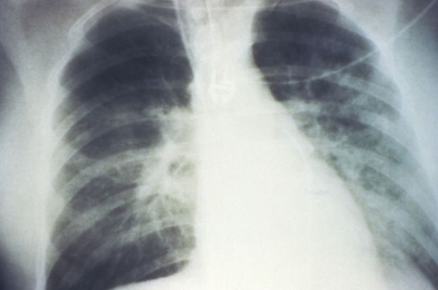 Pulmones afectados por el hantavirus.