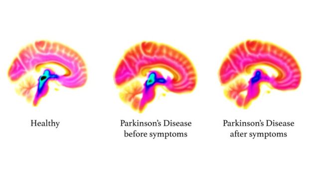 Tomografias do crânio mostram uma redução na serotonina (área azul/preta) à medida que o Parkinson avança