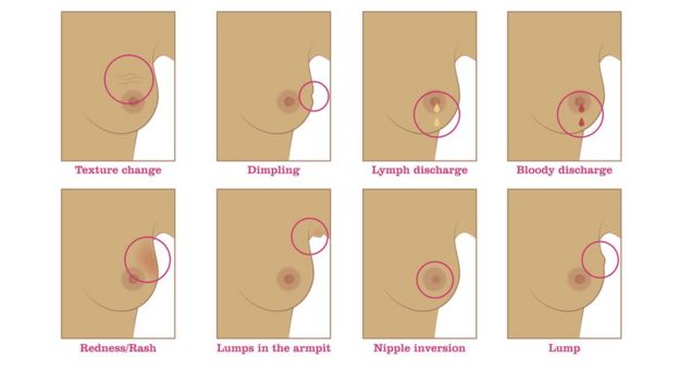 Graphic image of breast cancer symptoms. These include texture change, dimpling, lymph discharge, bloody discharge, redness or rash, a lump in the armpit, nipple inversion and a breast lump