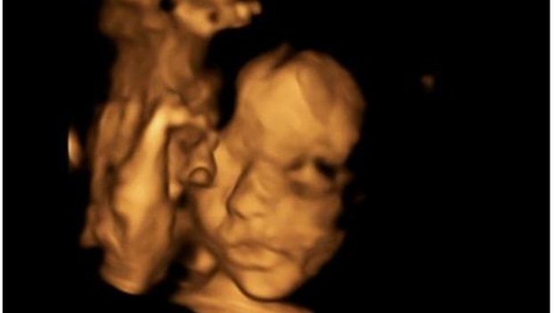 Ultrassonografia da bebÃª de Bethan Simpson, Eloise