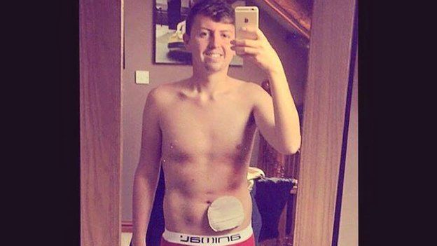 Luke Bennett's selfie with his colostomy bag