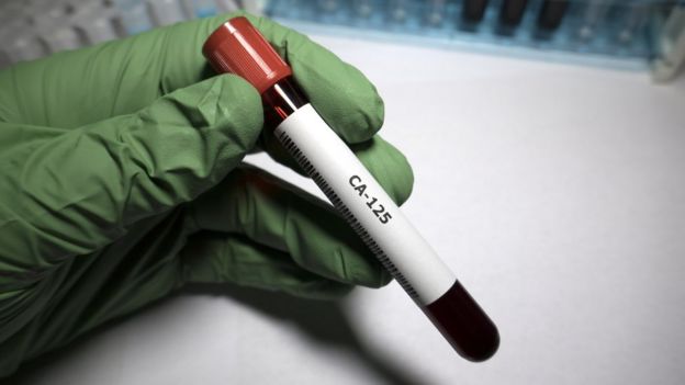 Ejemplo de prueba de sangre CA-125
