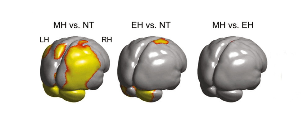 Comparación de los cerebros de neandertales, humanos modernos y primeros Homo sapiens.