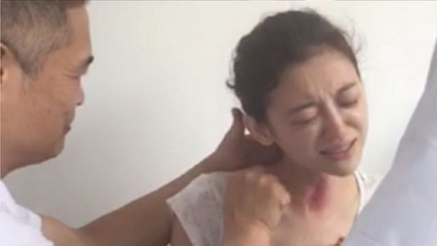 Picture of Xu Ting undergoing gua sha