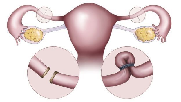 Ilustración que muestra el útero con las trompas de Falopio