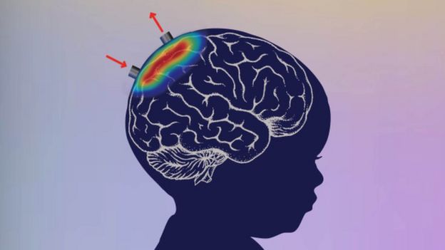 The device shines red and infra-red light into the baby's brain