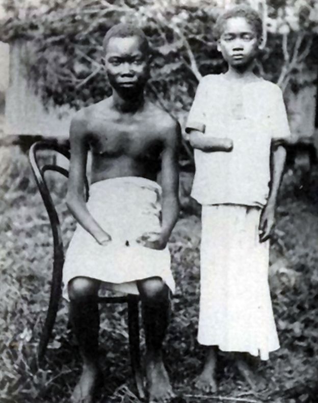 Dos jóvenes mutilados