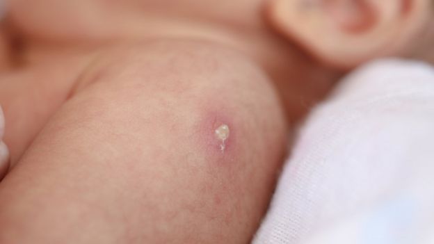 Braço de bebê com pequene ferida causada por injeção
