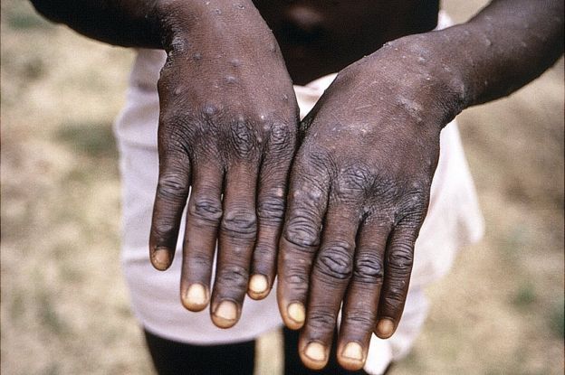 Hombre afectado por la viruela de los monos muestra sus manos en República Democrática del Congo en 1997.
