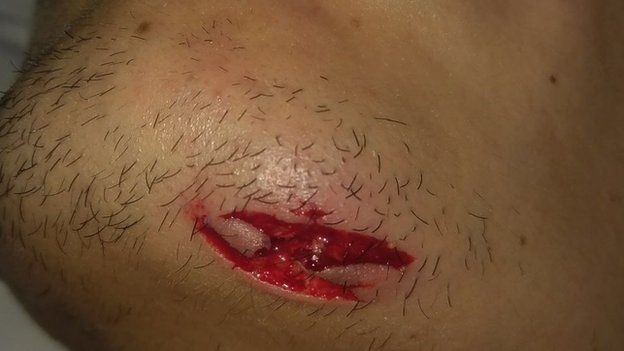 A deep gash on the chin was among the injuries sustained by Andres Gutierrez
