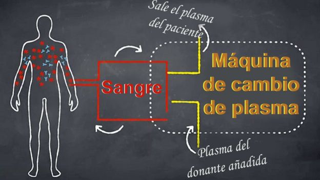 Proceso para cambiar plasma.