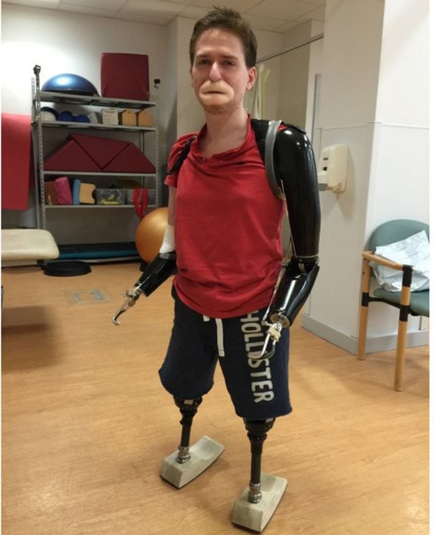 The Quadruple Amputee Who Needs The Correct Prosthetic - BBC News