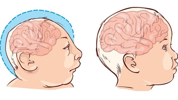 Ilustraciones de niño con microcefalia y niño con un cerebro normal