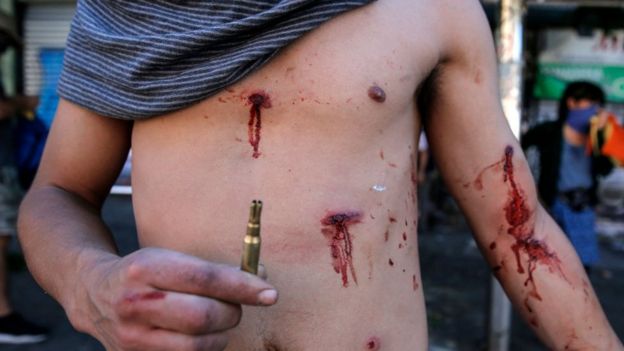Joven muestra heridas de perdigones recibidas durante las protestas.