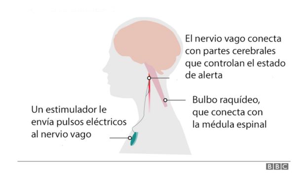 Ilustración de cómo funciona la terapia