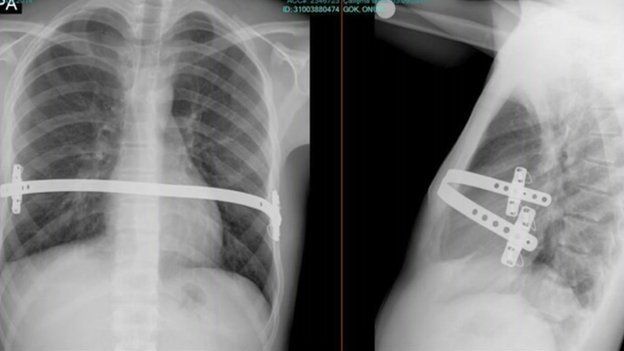 Chest x-rays show the brace