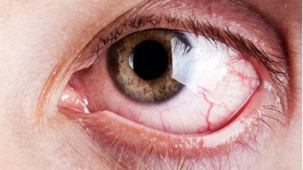 Eye irritation caused by novelty contact lenses