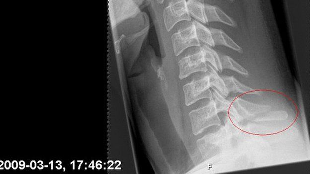 An x-ray of Susanne Najafi's broken neck