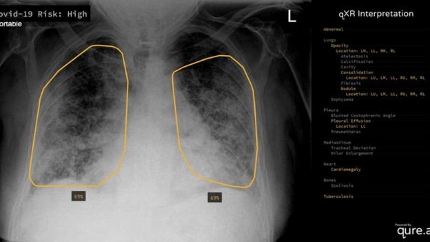 Lung x-ray examined by Qure.ai