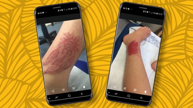 Cicatriz del atrapasueños que Mary se hizo hacer en el tobillo pensando que sería un tatuaje temporal.