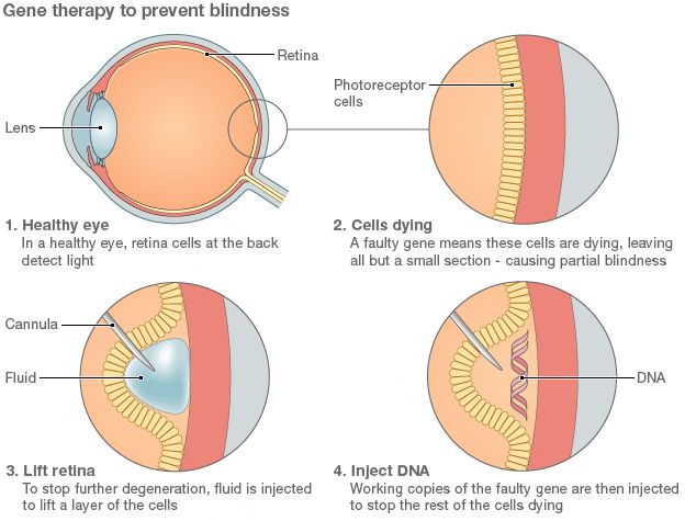 Graphic showing gene therapy to prevent blindness