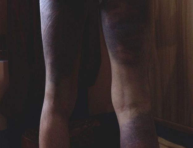 Bruising on the back of the legs of an alleged victim