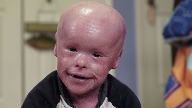 கார்லிகுயின் இச்தோசிஸ் என்கிற மேரபணு குறைபாடு உடைய குழந்தையின் தோற்றம் (கோப்புப்படம்)