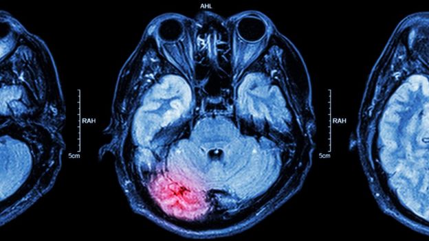 Lesión cerebral