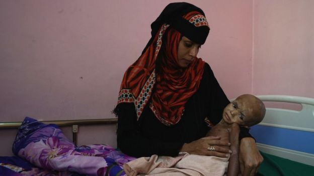 A mother is pictured in a clinic near Hudaydah with her child who is malnourished.