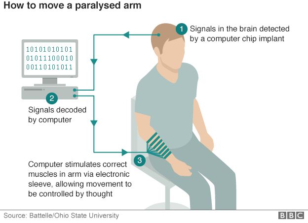 Как двигать парализованной рукой