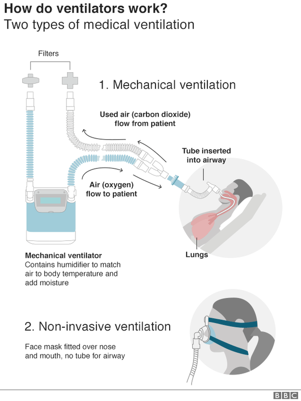 Graphicshowing two common types of medical ventilation