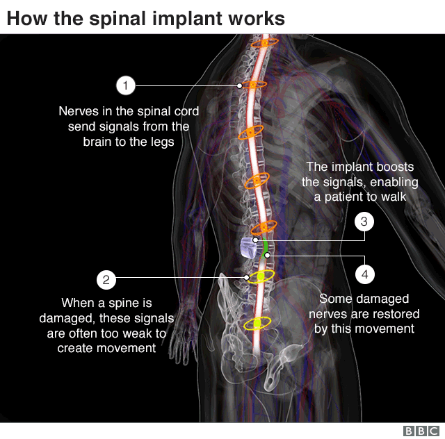 Spinal Implant Helps Three Paralysed Men Walk Again Bbc News 6984