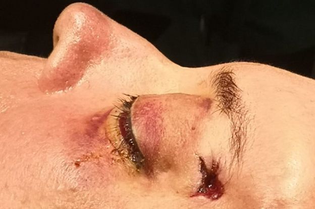 La bala le entró por la sien izquierda y tuvieron que sacarla por el pómulo derecho.