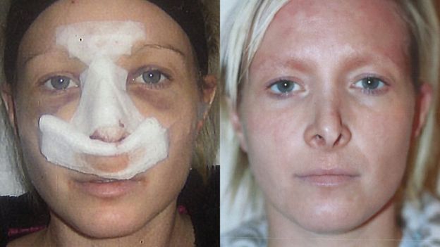 Cosmetic Surgery Woman Scarred After Procedure In Turkey Bbc News