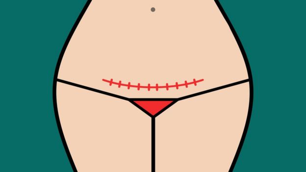 Ilustração mostra cicatriz em barriga de mulher após cesariana