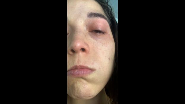 ब्लीचले उनको आँखामा चोट पुर्‍यायो