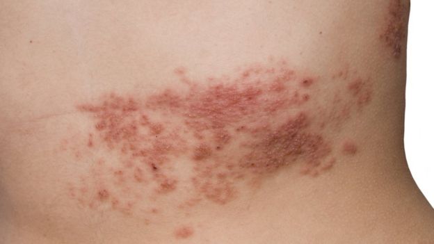 Herpes zóster en el abdomen.