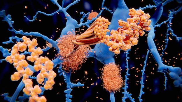 Amyloid beta protein in neurons in the brain