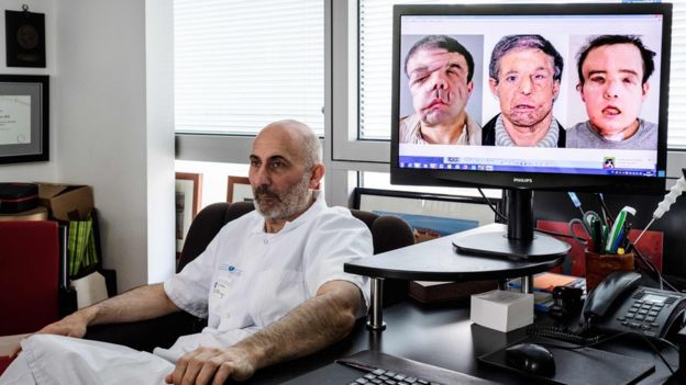 French medicine professor Laurent Lantieri, a specialist in hand and face transplant, poses next to a screen showing different steps of his patient Jerome Hamon"s surgery