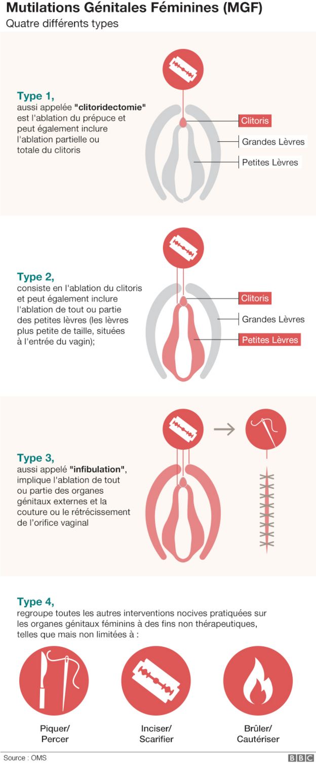 Il existe quatre types de mutilation gÃ©nitale fÃ©minine ou MGF