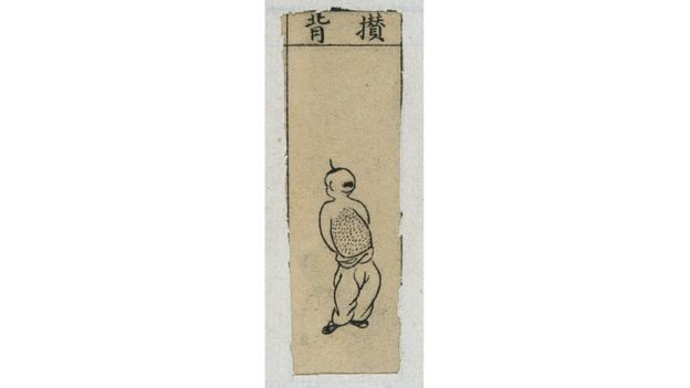 Ilustración de pústulas "juntas en la espalda" de "El espejo de oro y calcedonia de enfermedades de la viruela" de China.